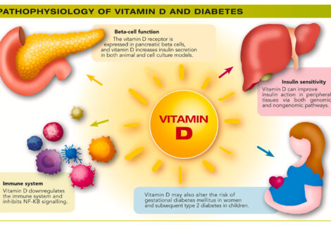 Mini-review. Vitamin D for the prevention of type 2 diabetes: Evidence and implications Mini-review. Vitamin D for the prevention of type 2 diabetes: Evidence and implications
